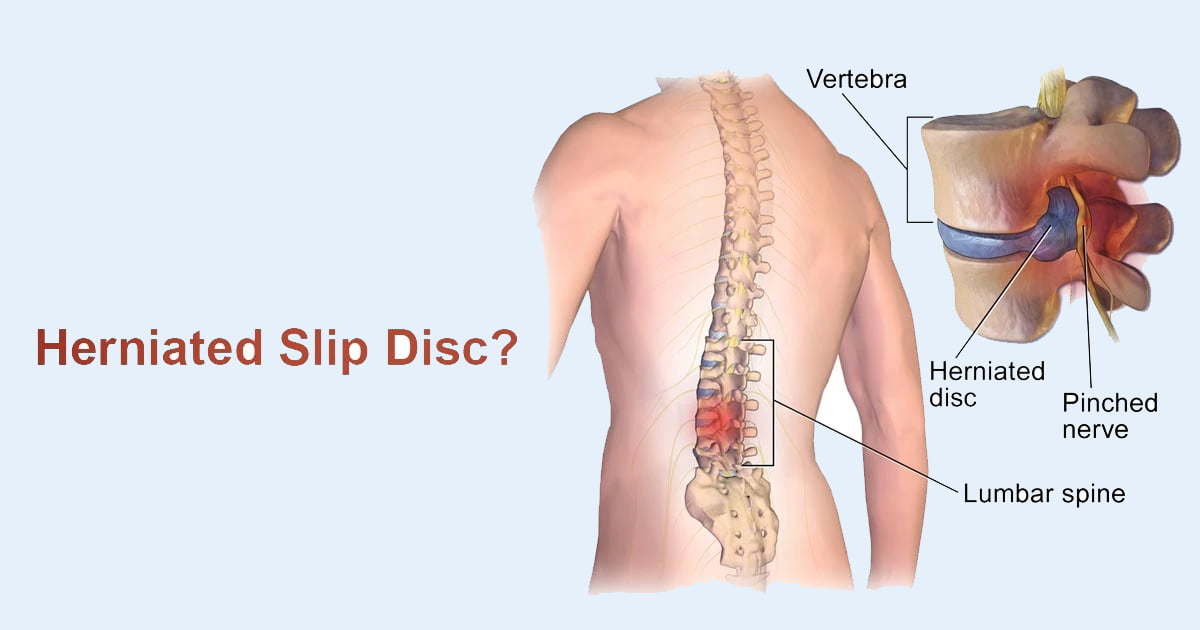 Slip Disc herniation