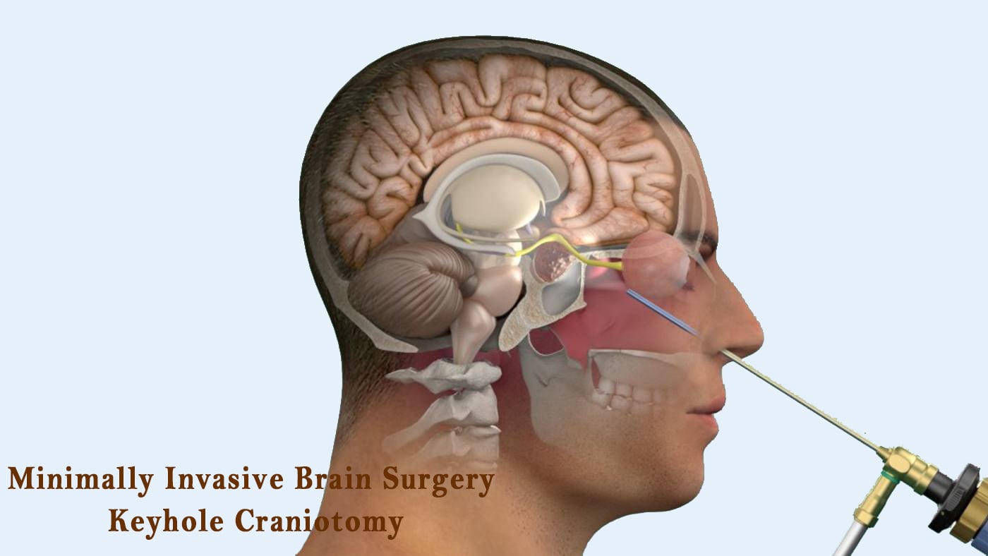 Minimally Invasive Brain Surgery Keyhole Craniotomy