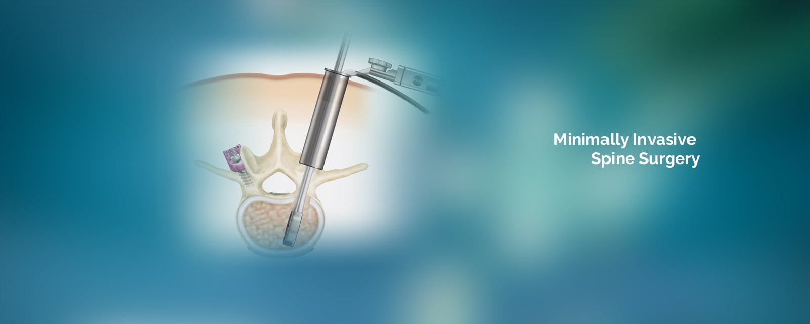 Minimally Invasive Spine Surgery india