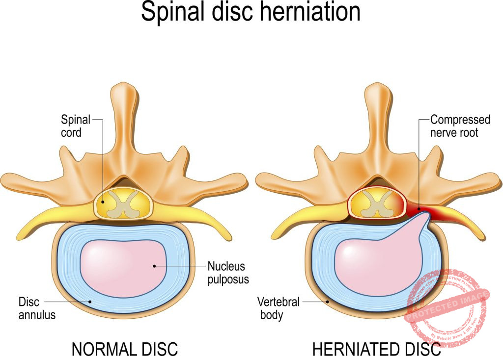 Cervical Disc Herniation Symptoms and Treatment Boston Brain and