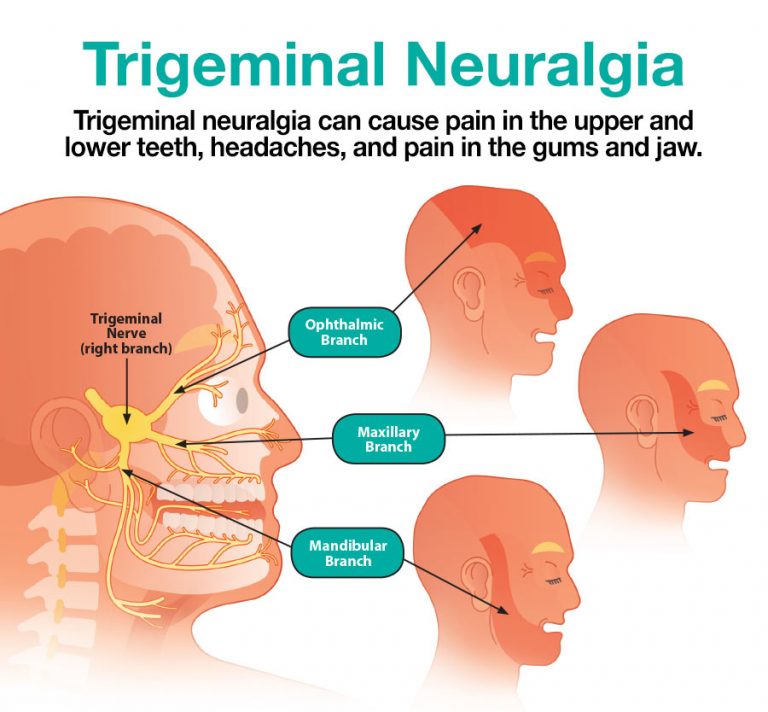 Trigeminal Neuralgia Treatment in Chennai Boston Brain and Spine Care