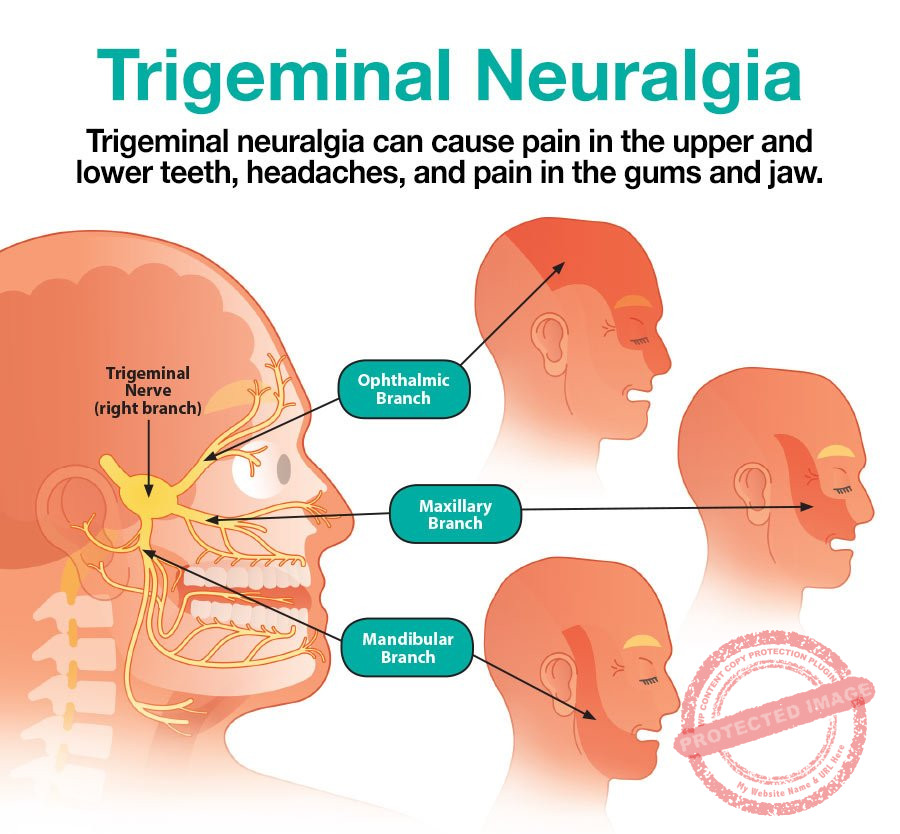 Trigeminal Neuralgia Treatment